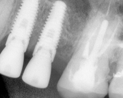 dental-implants