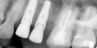 dental-implants