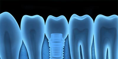 dentalimplants2