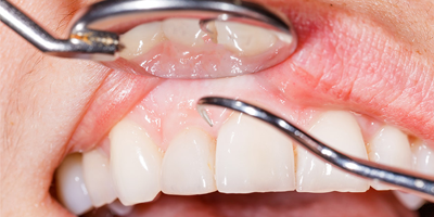 gumtreatment1