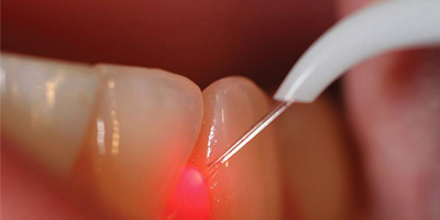 gumtreatment2